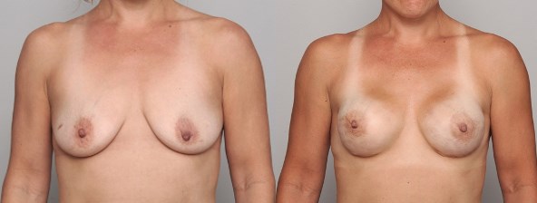 breast-recon-01112017